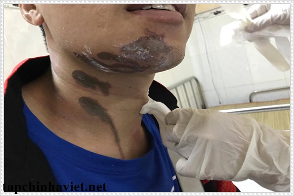 Bị bỏng bởi dung dịch vệ sinh bồn nước